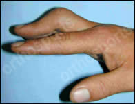 Boutonniere Deformity